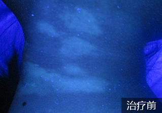 成都白癜风哪个医院好